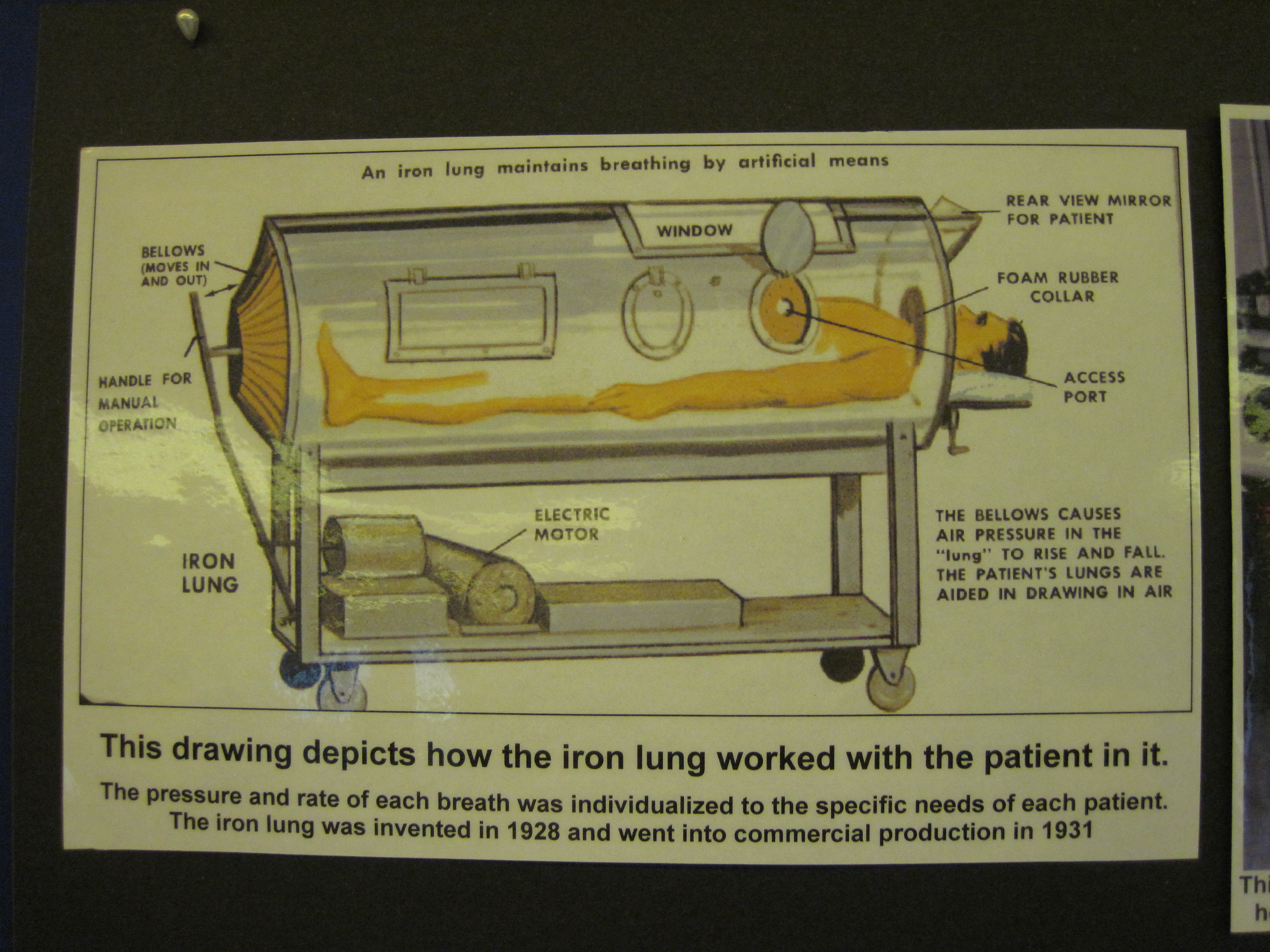 This picture depicts how the iron lung worked with the patient in it